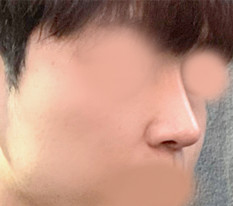 남자코성형 후기입니다