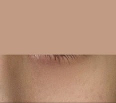 눈밑지방재배치로 인상이 바뀌었어요!