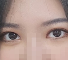 눈절개,앞트임 후기욤 : )