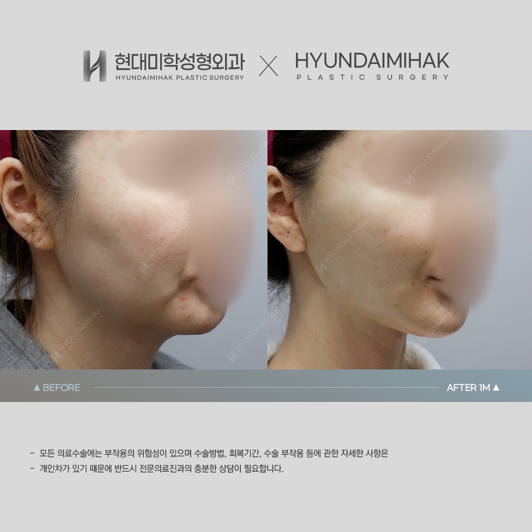 [동안성형] 실리프팅 1개월 차