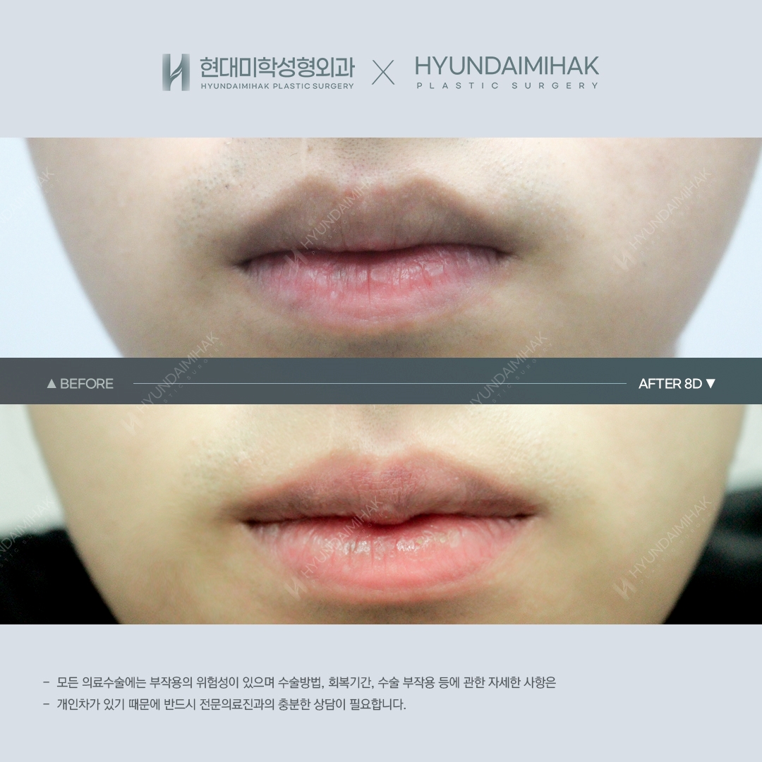 [입술성형] 큐피트 입술성형 8일 차