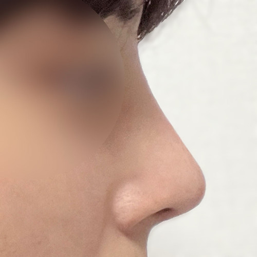 남자 첫코성형 도전기