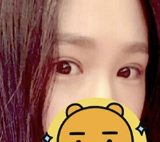 눈재수술한지 두달 됐어요 ㅎ_ㅎ