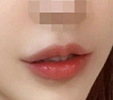 입꼬리수술 받은 기념으로 후기 올립니당 ㅎ