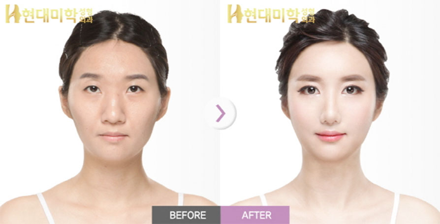 눈(매몰),앞트임,뒷트임,밑트임 코(절골+비중격+콧볼줄임), 지방이식