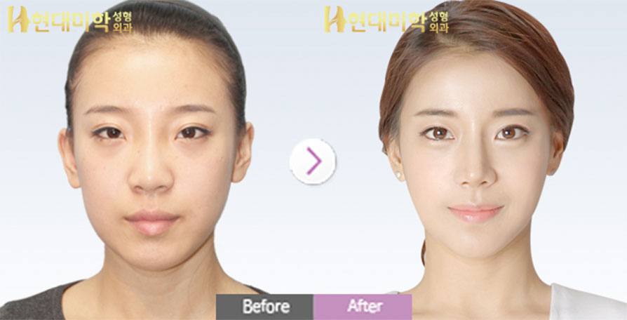 앞트임, 코수술, 비중격연골이식, 실리콘, 사각턱, 지방이식