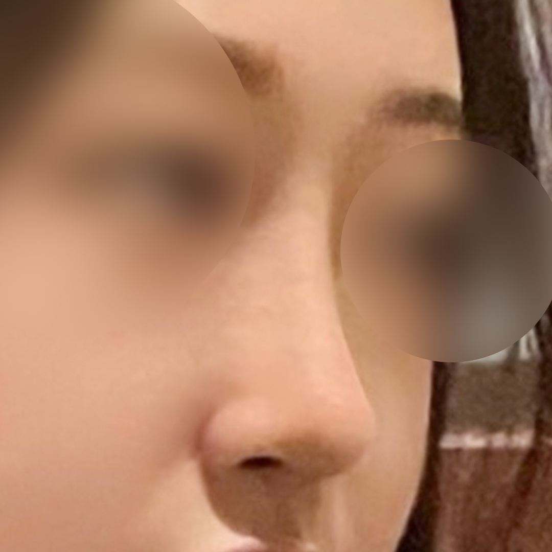 현대미학 성형외과 첫코 후기