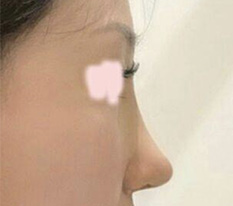 코수술 후기 올려봐요 어때요??