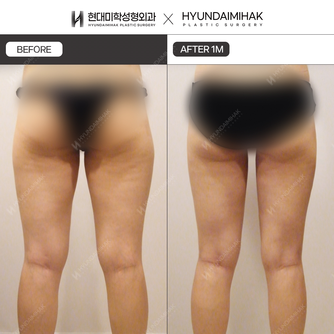 허벅지 지방흡입 1개월차