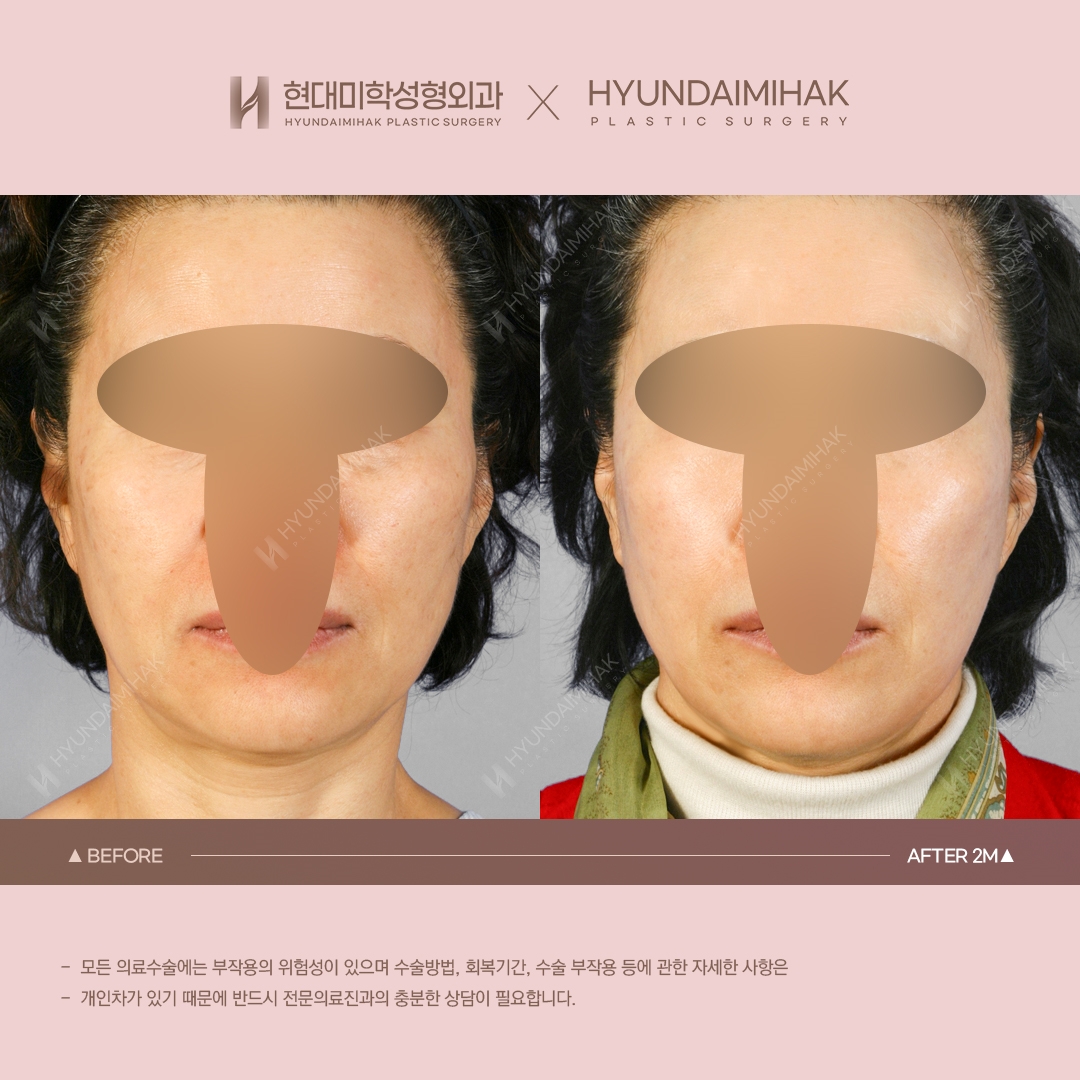 [동안성형] 실리프팅 2개월 차