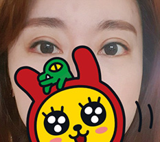 나이먹고 눈성형이라니... 그래도 완전 만족합니다 ^^