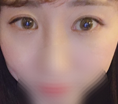 눈성형/앞트임 한 1개월차 후기~~~~~