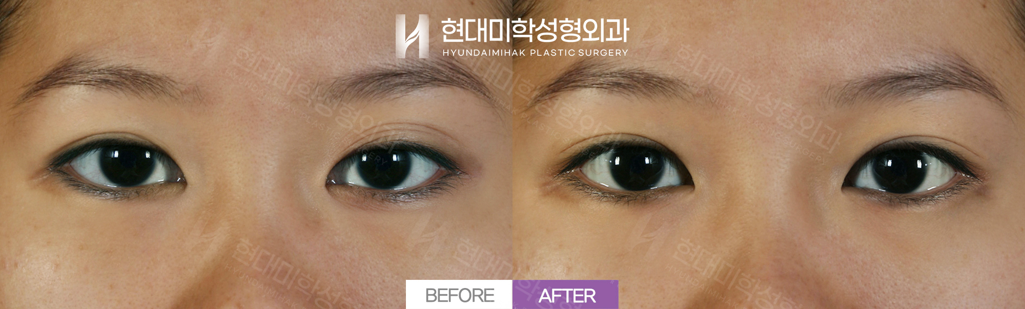 자연유착 + 쌍꺼풀재수술