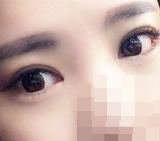 눈절개+눈매교정+앞,뒤,밑 트임