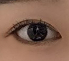 재수술 끝났어요!