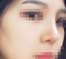 코수술후기~~!!