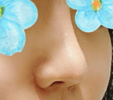 코재수술 완전 만족☆