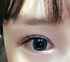 수술하고 너무 만족스러워서 홈페이지에도 남겨요^^