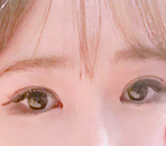 눈매교정받았어욤@_@