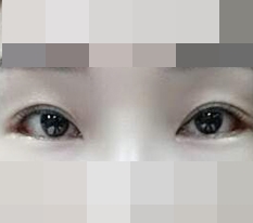 뒤+밑트임 후기