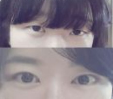 눈 수술하고 예뻐졌다는~ㅎㅎ