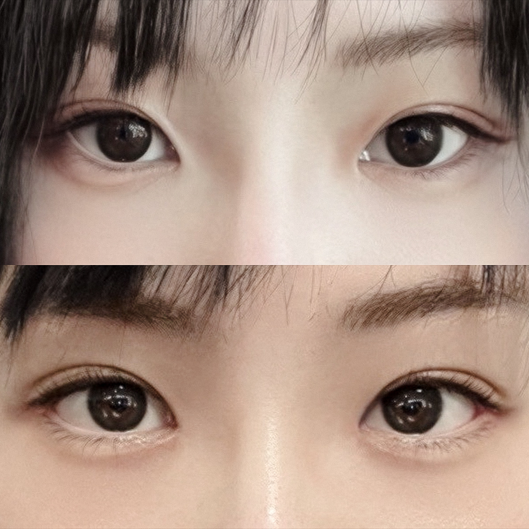 뒤밑트임 맛집✨현대미학에서 수술후 1달차