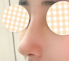 하이코 제거하고 코수술 하길 잘한것 같아용
