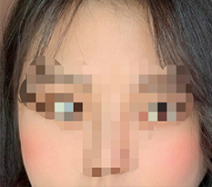 광대재수술 받았습니다~ 예쁘게 잘 해주셔서 감사해요^^
