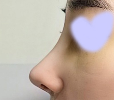코재수술 한지 2주 지났어요~~!