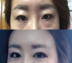 재수술 너무 마음에들어서 후기써요 ㅋㅋ