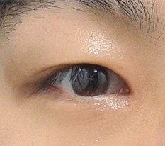 앞트임 실패 후..