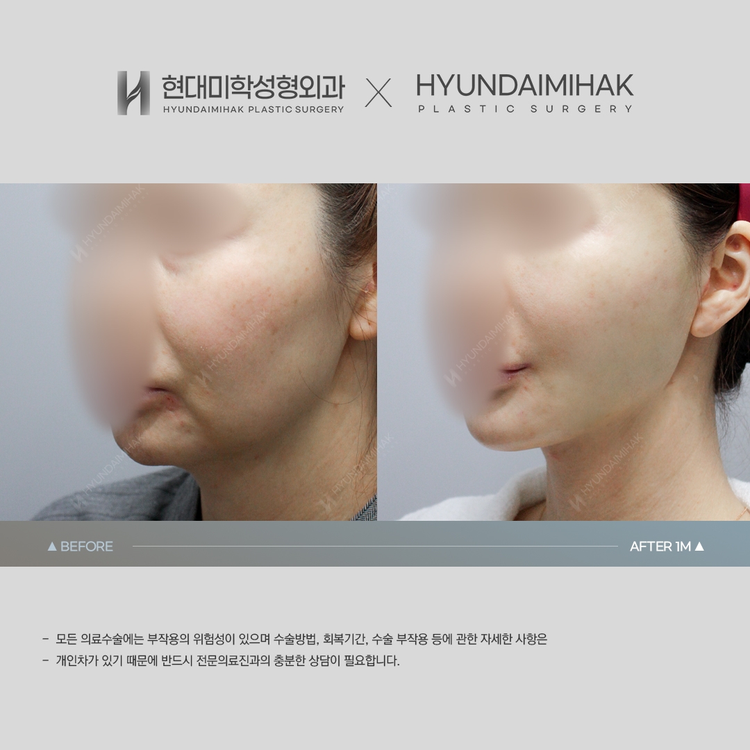[동안성형] 실리프팅 1개월 차