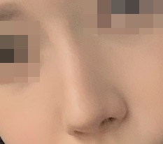 매부리코수술 받았는데 여성스러워지고 이뻐졌대용'ㅜ'