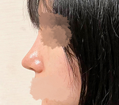 얄쌍한 코 완성