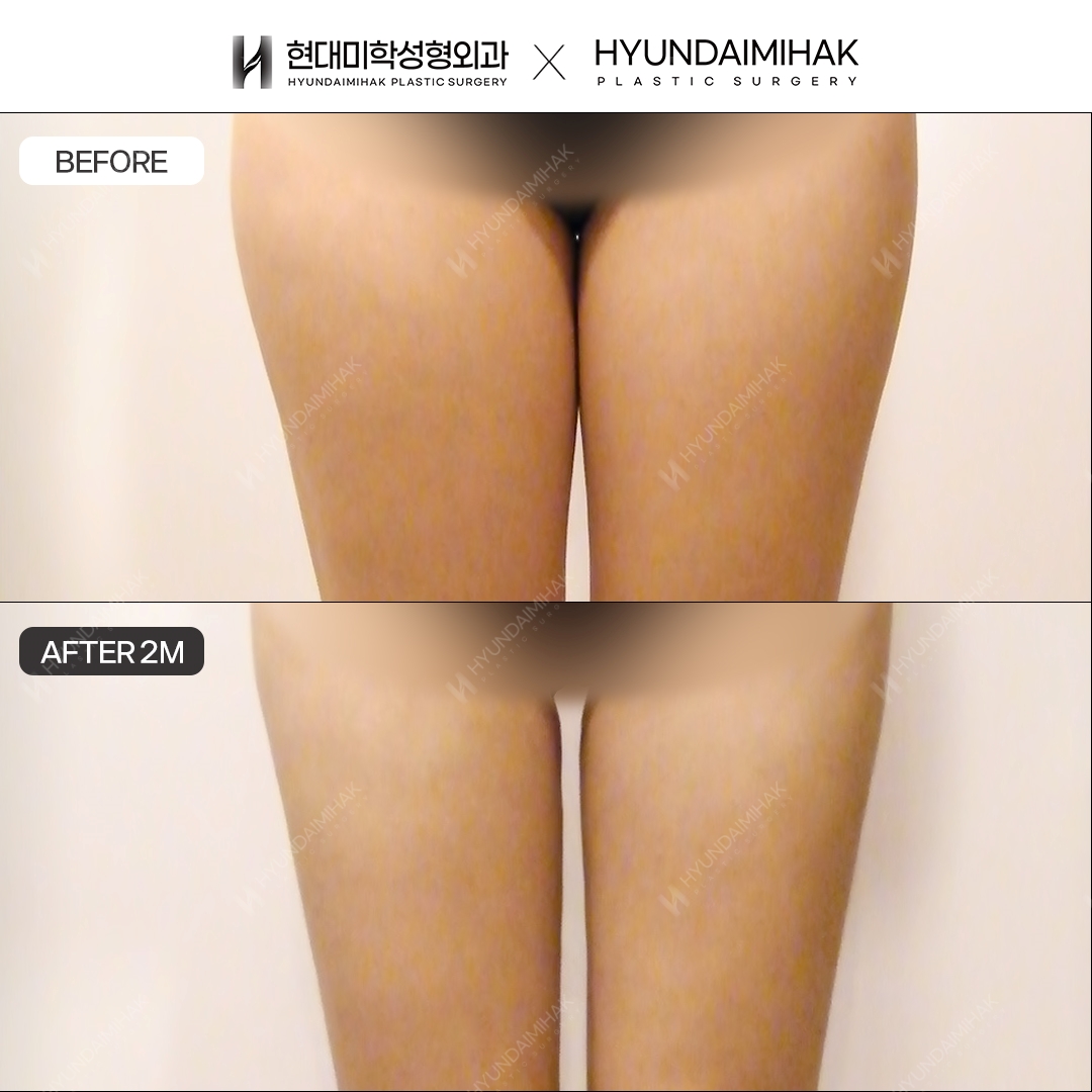 허벅지 지방흡입 2개월차