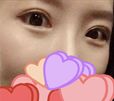 눈재수술 후기 드디어 올려보네요^^