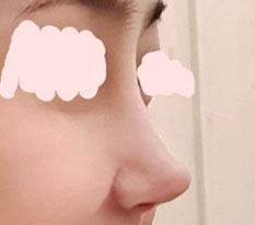 코재수술 후 변화