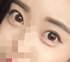 눈절개,앞트임해쪄여