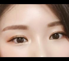 눈수술 후기남겨요^^