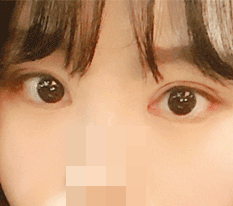 저 눈 완벽하게 됐어요!