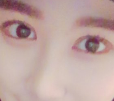 지방흡입,눈,코 후기올려용