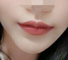 입꼬리수술 대망의 6개월 후기 ㅜㅜㅜㅜㅜㅜ