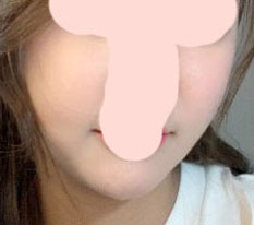 광대수술 2달차 실제후기 올림~