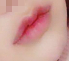 현대미학 입꼬리+큐피트입술성형 강추