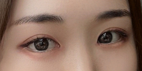 #눈재수술 #절개쌍꺼풀재수술 #듀얼트임 #눈매교정