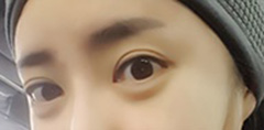 쌍꺼풀 절개