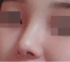 코수술