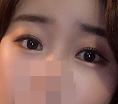 쌍꺼풀 있다고 눈성형 안하는건 정말 손해인 것 같아요 ㅋㅋ (듀얼트임+앞트임 후기)