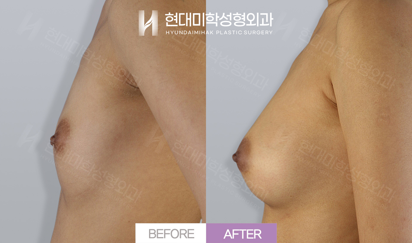가슴확대(자가지방)
