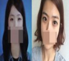 절개+앞트임^^